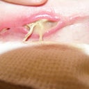 Necrotic tissue death after abdomnioplasty done by Dr. Gallico