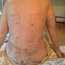 My back is obviously pretty beaten up.....a lot of lipo....so swollen and bruised.