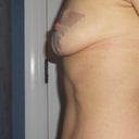 Side view of L breast, my bigger one :-)!! March 15th - 15 hours after surgery.