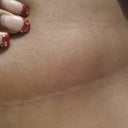 right side scar area 3 months
