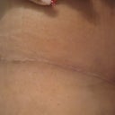 TT Scar 3 months