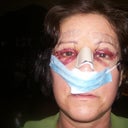 1st day after surgery