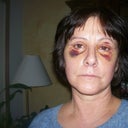 5 days after - just had the stitches removed & nose cast.