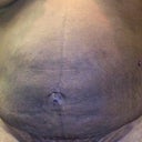 Post-lipo Front (1 day past lipo)