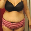 me before the surgery.