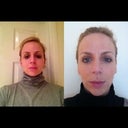 Front profile before and 3wks after