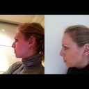 Side profile before and three weeks after