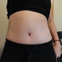 3 weeks post op