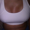 2 days after surgery