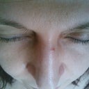 NO Eyelashes at all
