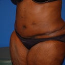 After tummy tuck surgery