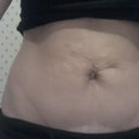 Before Vaser Lipo