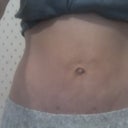 After Vaser Lipo - at 5 weeks