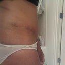 Day 40 - Healing going well.  I'm 3 weeks into my scar therapy and I like the results.