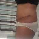 Day 40 - Healing going well.  I'm 3 weeks into my scar therapy and I like the results.