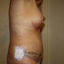2 weeks post-op.  You can see the drain I still have in.