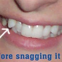 Before snagging it up with Invisalign