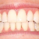 With invisalign - still 6 weeks to go