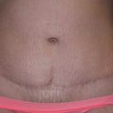 scar after 8 moths posy op