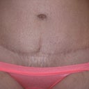 scar after 8 moths posy op