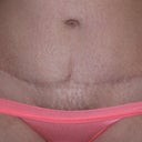 scar after 8 moths posy op