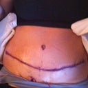 One day post op