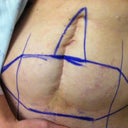right before surgery.