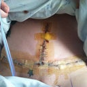 Day after surgery.
