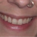 My lips before Restylane