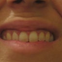 My lips 2 years after Restylane