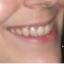 Lips before Restylane