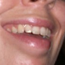 Lips a few days after Restylane