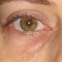 Eyes 4 1/2 years after Restylane. Raised area still visible.