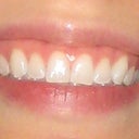 This is my smile before invisalign.