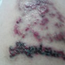 2 days after 2nd treament