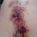 2 days after 2nd treatment