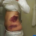 After - Day 1 Side View (bruised on Left Side only)