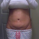 After - Day 1 Front View (swollen and lumpy)