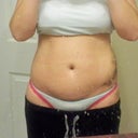 After - Day 10 - Less swollen, lumps are going away