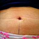 New belly button