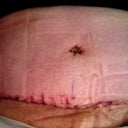 Post op day 5