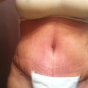 11 days post op.  You can see my navel is oval shaped.  Starting at 15 days post op I will place a small marble thing in it to start rounding it out.  Soooo happy...swelling and all.