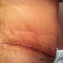 Close up of incision 11 days post op.  The shiny stuff is the Kelo-cote scar treatment.