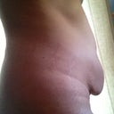 Side view Pre Op