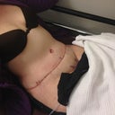 One day post op. I am sitting at a 45degree angle