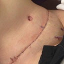 Close up on incision. Looks pretty good. Doc agrees.
