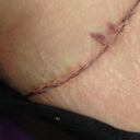 Incision on right side. Seems pretty straight.