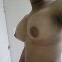 DAY 3 Post op, riding a little high