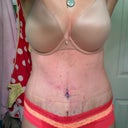 i promise i didn't pee on myself...i had just cleaned my BB with soap/water/ointment :) thrilled to be standing tall & lean. i can't imagine the thrill when my swelling is gone. i need a bumper sticker "I heart TT!"