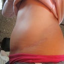 2013 - 9 months post scar revision.  1 yr 9 mo after TT.  Scar fading nicely!